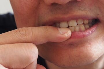 Man biting nail with his skin peeling on finger 