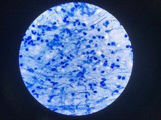 Smear sputum acid fast bacilli stain negative non Tuberculosis.