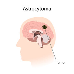 Astrocytoma. Brain cancer, tumor with explanations. Inner view.
