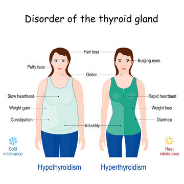 comparison and difference between Hyperthyroidism and Hypothyroidism.