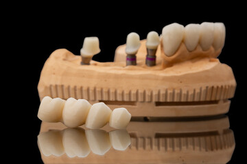 Close-up photo of a dental upper jaw prosthesis on black glass background. Artificial jaw with veneers, crowns and dental bridge of 4 teeth by side. Tooth recovery with implant. Prosthetic dentistry. © MONIUK ANDRII