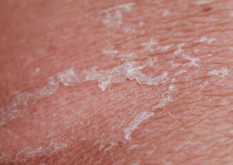 texture of problematic human skin close-up with burn, redness and peeling after sunburn