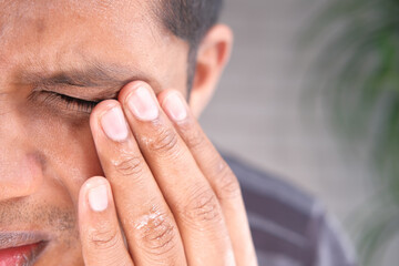 Fototapeta premium Close up of upset man suffering from strong eye pain