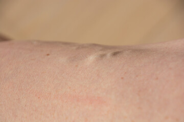 close-up of female leg with pronounced varicose veins before an operation