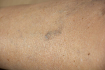 Fototapeta premium spider veins on a leg of an older women with a blue capillary hemorrhage
