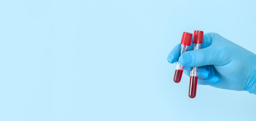 Researcher holding blood sample flasks of patients in laboratory