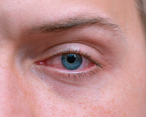 Close up irritated infected red bloodshot eyes. Conjunctivitis. Inflammation of the eyes. Mens red eye close-up, fatigue, problems with blood vessels. Red eye for irritation of the sclera - obrazy, fototapety, plakaty