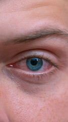 Close up irritated infected red bloodshot eyes. Conjunctivitis. Inflammation of the eyes. Mens red eye close-up, fatigue, problems with blood vessels. Red eye for irritation of the sclera