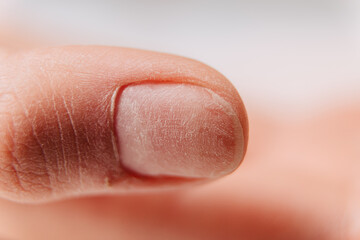 Manicure process. The uneven surface of the nail on the thumb after grinding.