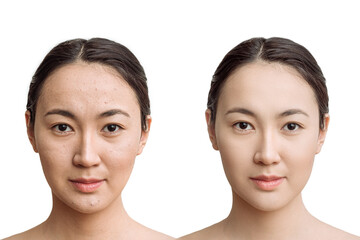 the concept of skin care before, after. young asian woman with bad skin with wrinkles and acne and...