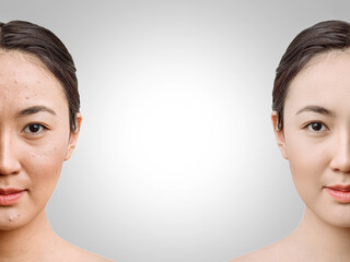 the concept of youth and skin care before, after. young Asian woman after the procedure, the beautician on grey background copy space