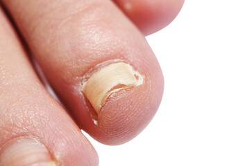 Dark detached toenail due to injury coming off. Peeling off the nail.

