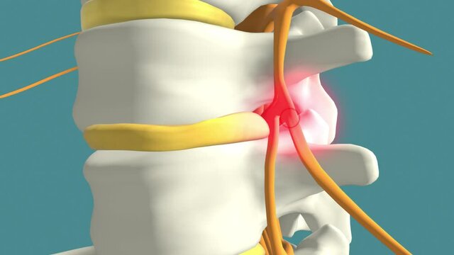 Spinal disc herniation causing lower back pain, 3d educational animation