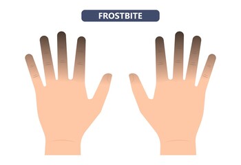 Frostbite treat toes cold ice improperly icing injury burn skin tissue white yellow black frozen Pain Numbness Tingling snow blistered loss muscle freeze first aid raynaud deep prevent