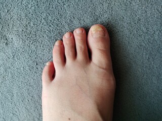 Nail fungus on the toes Nail disease awaiting treatment