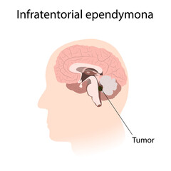 Infratentorial ependymona. Brain cancer, tumor with explanations.