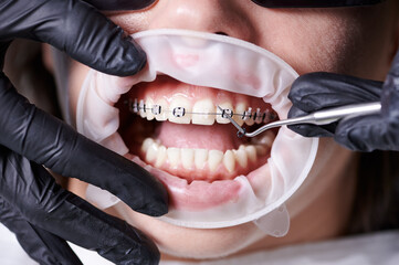 Close up view on dentist's hands in black gloves taking off old black rubber bands from ceramic...