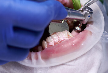 Close up of periodontist using dental polisher and mirror cleaning teeth of patient, with cheek...