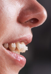 Close up of young woman with opened mouth demonstrating white teeth with orthodontic brackets. Female patient during dental braces treatment. Concept of orthodontic treatment and stomatology.