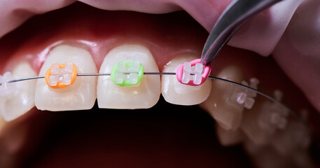Macro snapshot of dental procedure, process of attaching colorful rubber bands to white ceramic...