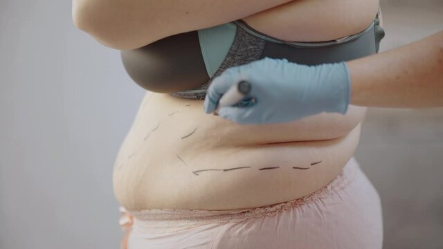 Plastic surgeon marking overweight female body preparing for liposuction, health