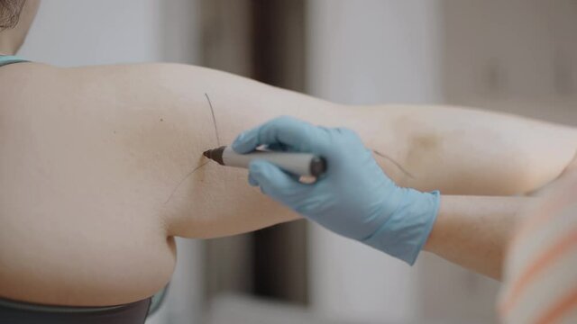 Surgeon drawing by marker on patient's arm, cosmetic surgical procedure, lift