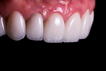 press ceramic veneers b2 color