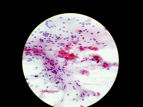 Normal endocervical cells and squamous epithelial cells of cervical human view in microscopy.Cytology criteria from pap smear.Medical background concept.