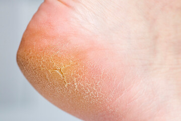 Close up of cracks on the heels. A persons heel with dry skin and cracks
