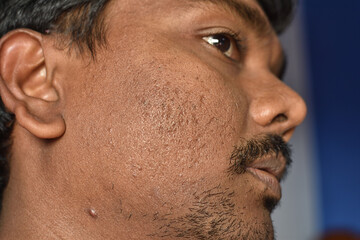Close up of pimples marks on man's face . Deep acne scars on the cheek.