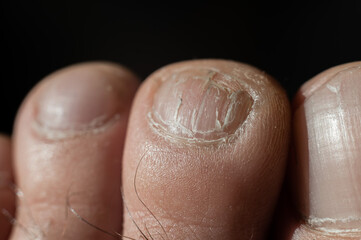 Close-up of male toes with a cracked nail