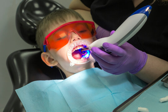 Modern caries treatment for a child. Children's dentistry. Little boy in protective orange glasses. Process treatment root canal or caries. Cleaning and prevention of teeth.