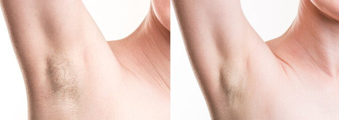 Woman with armpit hair, female hairy armpit, before and after shaving. Skinny girl with hair...
