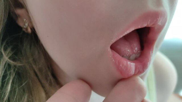 Dentist wiggles a baby's milk tooth with tweezers