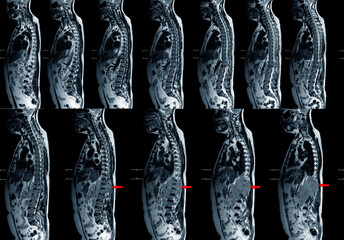 Magnetic resonance imaging of human spine. MRI of Lumbar and Thoracic spine finding mass or tumor.
