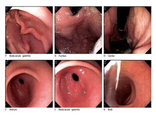 Esophagogastroduodenoscopy report showing acute on chronic gastritis.Medical healthcare concept.Soft and blurry when views full solution.