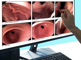 Close up Doctors point out the computer screen, report of gastrointestinal endoscopy, medical imaging EGD looking for structures in the esophagus.