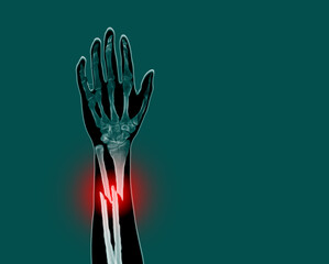 Film x-ray forearm simulating Photography finding fracture at left ulnar and left radial diaphysis with displacement on red mark.Medical imaging concept.