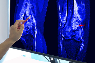 Magnetic Resonance Imaging (MRI) OF RIGHT KNEE Suggestive of malignant bone tumor, involving...
