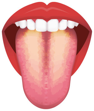 Tongue’s health sign vector illustration ( Yellow coated Tongue )