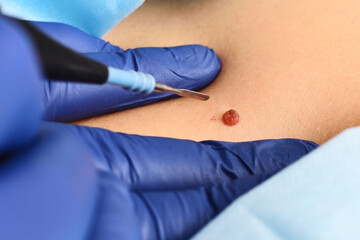 A dermatologist surgeon removes a neoplasm - a mole or nevus from the patient's abdomen with a radio wave knife. Aesthetic surgery, prevention of melanoma.