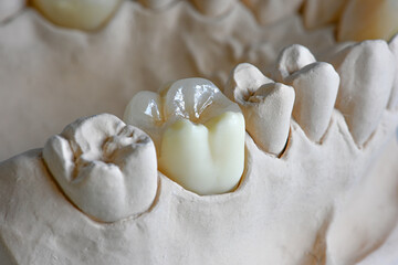 Teilkrone auf Modell