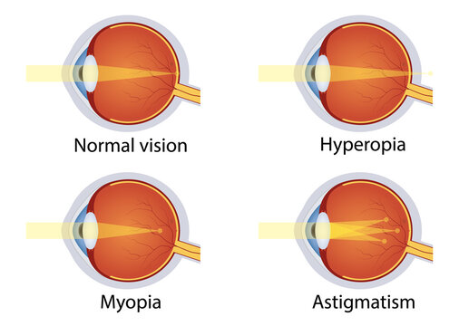 Vision disorders. Concept of eyes defect. Normal vision, hyperopia, myopia, astigmatism. Anatomy eyeball. Vector