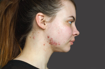 Red pimples on the skin of a young girl close-up. Acne on the face of a teenage girl.  Problems and treatment of acne in young people. Skin rashes, allergies. Keloids. The concept of puberty.