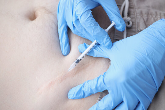 Gloved doctor injects the keloid scar closeup