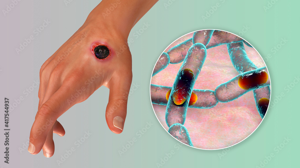 Canvas Prints cutaneous anthrax, the most common form of anthrax