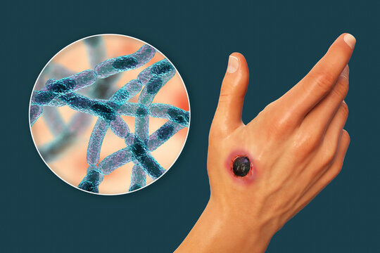 Cutaneous anthrax, the most common form of anthrax
