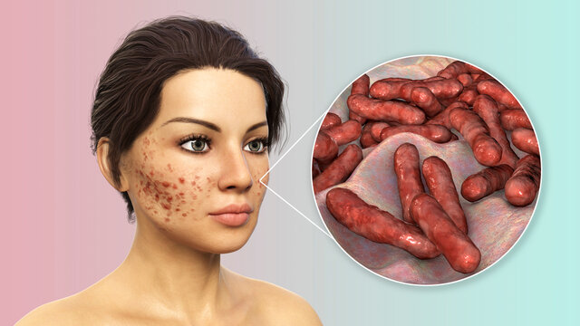 Acne vulgaris on skin