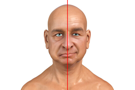 Facial nerve paralysis