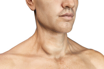 Fototapeta premium Thyroid cancer, tumor inside thyroid gland